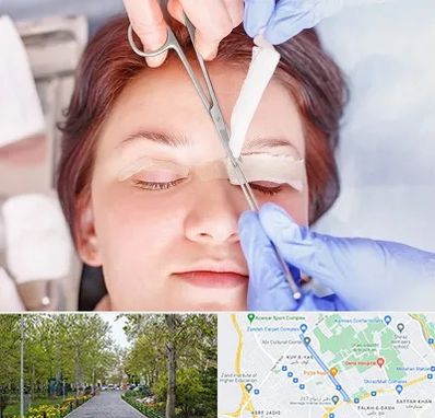 جراحی پلک افتاده در قدوسی غربی شیراز