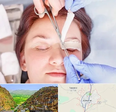 جراحی پلک افتاده در کامیاران