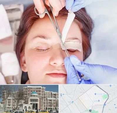 جراحی پلک افتاده در طلاب مشهد