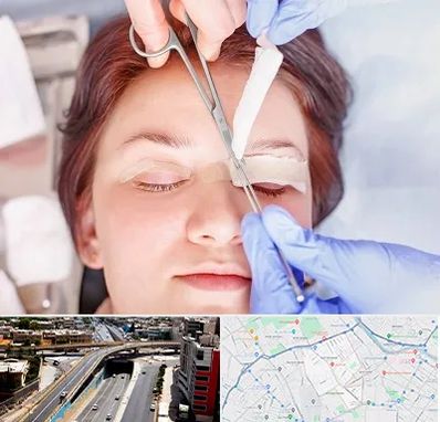 جراحی پلک افتاده در ستارخان شیراز