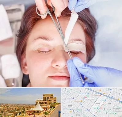 جراحی پلک افتاده در هاشمیه مشهد