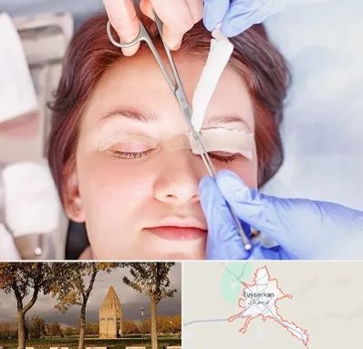 جراحی پلک افتاده در تویسرکان