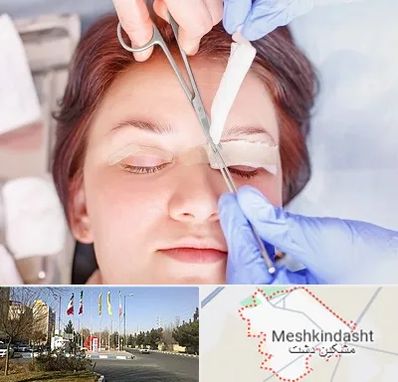 جراحی پلک افتاده در مشکین دشت