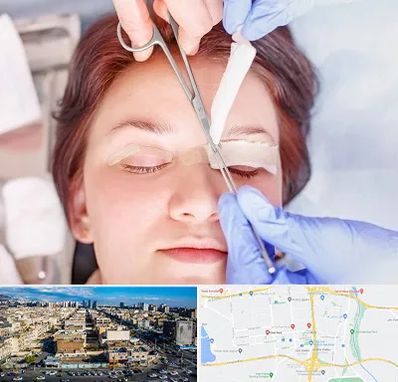جراحی پلک افتاده در شهرک راه آهن