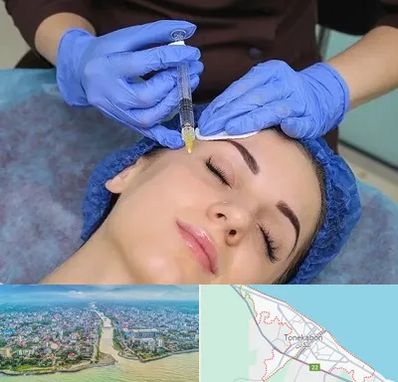 تزریق پروفایلو در تنکابن