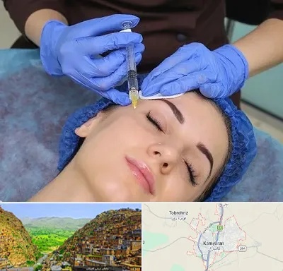 تزریق پروفایلو در کامیاران