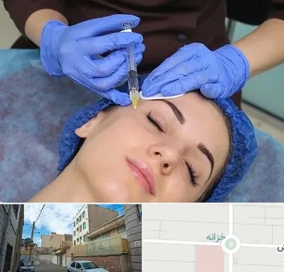 تزریق پروفایلو در خزانه