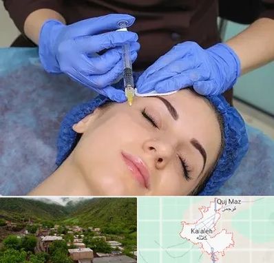 تزریق پروفایلو در کلاله