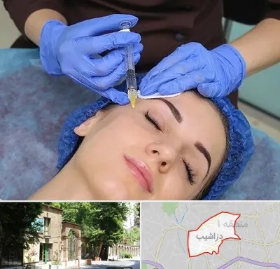 تزریق پروفایلو در دزاشیب
