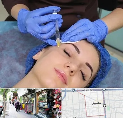 تزریق پروفایلو در سلسبیل