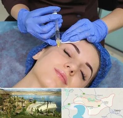 تزریق پروفایلو در شبستر