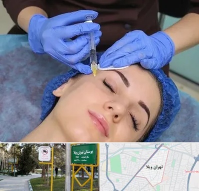تزریق پروفایلو در تهران ویلا