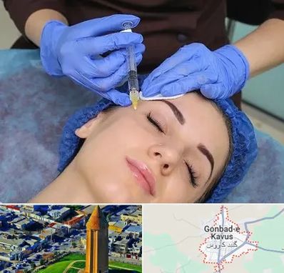 تزریق پروفایلو در گنبد کاووس