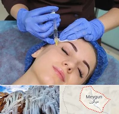 تزریق پروفایلو در میگون