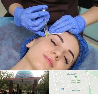 تزریق پروفایلو در کیانشهر