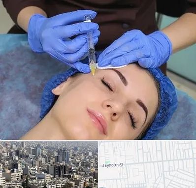 تزریق پروفایلو در جیحون