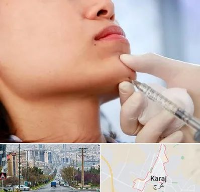 زاویه سازی صورت در گوهردشت کرج 