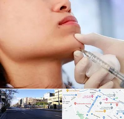 زاویه سازی صورت در خیابان ملاصدرا شیراز 