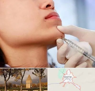 زاویه سازی صورت در تویسرکان