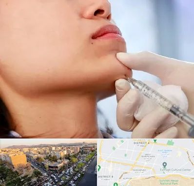 زاویه سازی صورت در تهرانپارس 