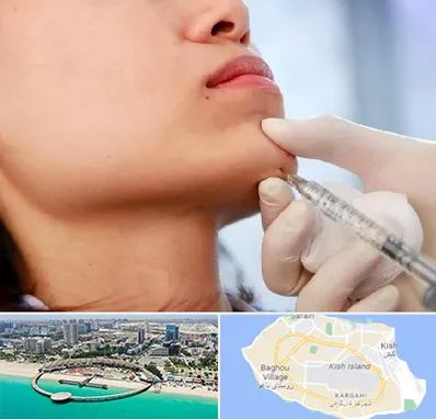 زاویه سازی صورت در کیش