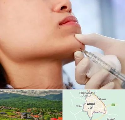 زاویه سازی صورت در آمل