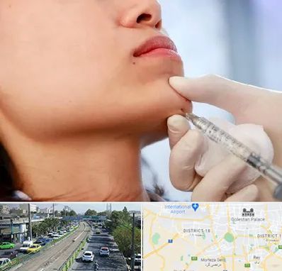 زاویه سازی صورت در جنوب تهران 