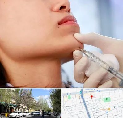 زاویه سازی صورت در کوی فیروز تبریز