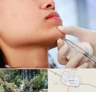 زاویه سازی صورت در شیروان
