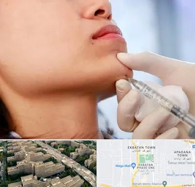 زاویه سازی صورت در اکباتان 