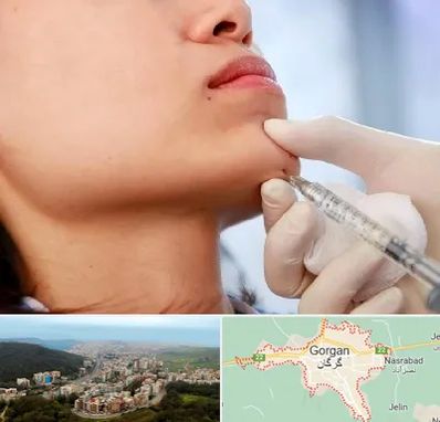 زاویه سازی صورت در گرگان