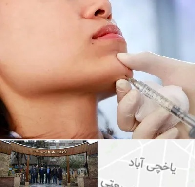 زاویه سازی صورت در یاخچی آباد