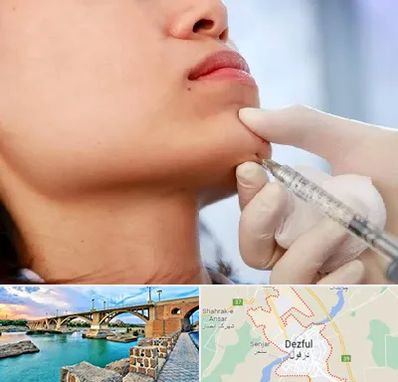 زاویه سازی صورت در دزفول