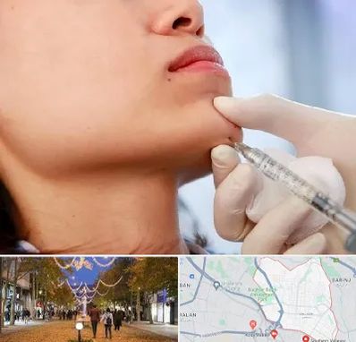 زاویه سازی صورت در ولیعصر ارومیه