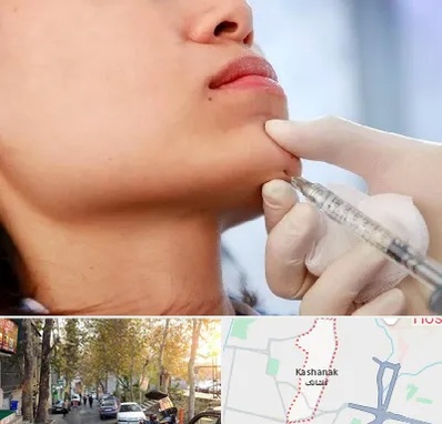 زاویه سازی صورت در کاشانک