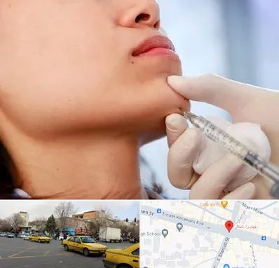 زاویه سازی صورت در شهناز تبریز