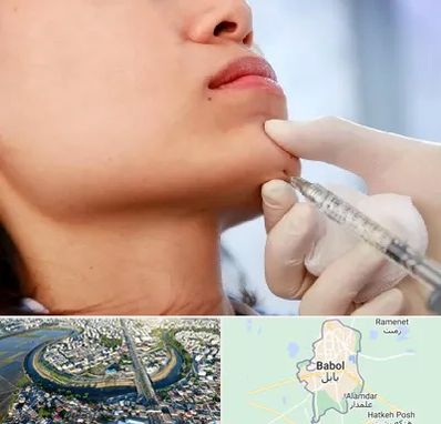 زاویه سازی صورت در بابل