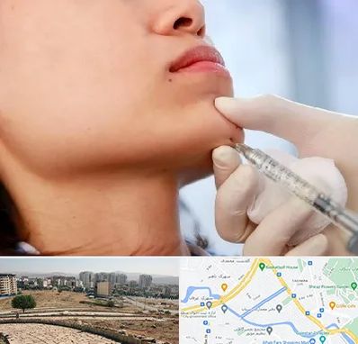 زاویه سازی صورت در کوی وحدت شیراز