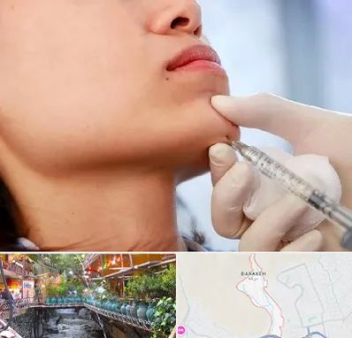 زاویه سازی صورت در درکه