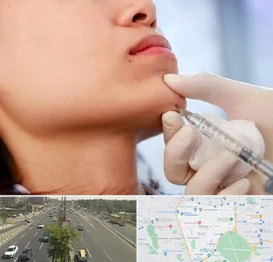 زاویه سازی صورت در منطقه 17 تهران 