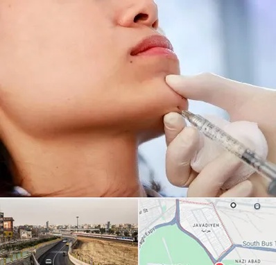 زاویه سازی صورت در جوادیه