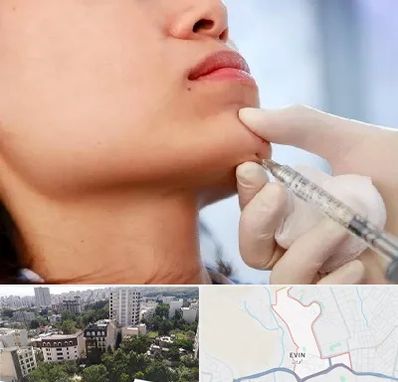 زاویه سازی صورت در اوین