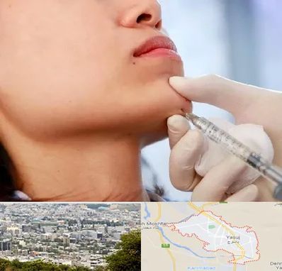 زاویه سازی صورت در یاسوج