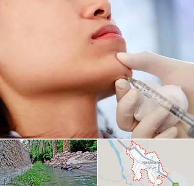 زاویه سازی صورت در سراوان