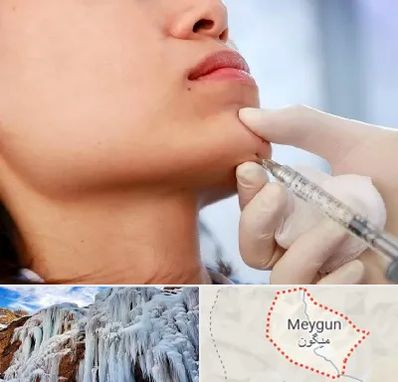 زاویه سازی صورت در میگون