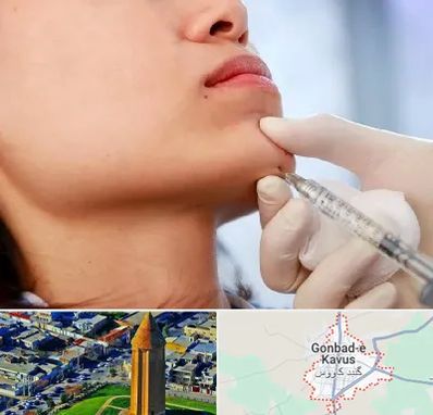 زاویه سازی صورت در گنبد کاووس