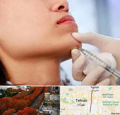 زاویه سازی صورت در ولیعصر 