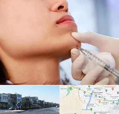 زاویه سازی صورت در شریعتی مشهد 