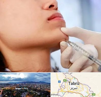 زاویه سازی صورت در تبریز