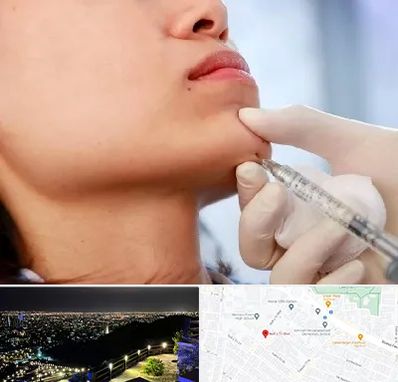 زاویه سازی صورت در هفت تیر مشهد 